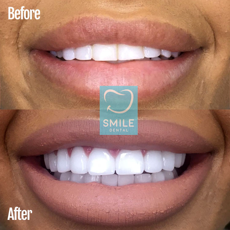 https://smiledentalturkey.com/uploads/blog/zirconium_veneers_turkey.jpg